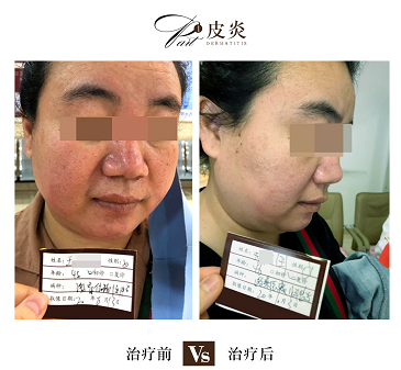 海口市治激素依赖性皮炎